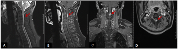 宏源证券 7年6次复发 vs 18个月无复发，抗IL-6R疗法改写59岁NMOSD患者病程轨迹